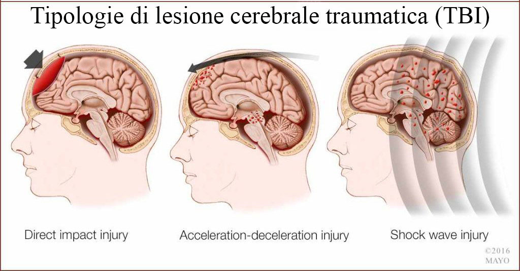 Cannabis terapeutica e lesione cerebrale traumatica