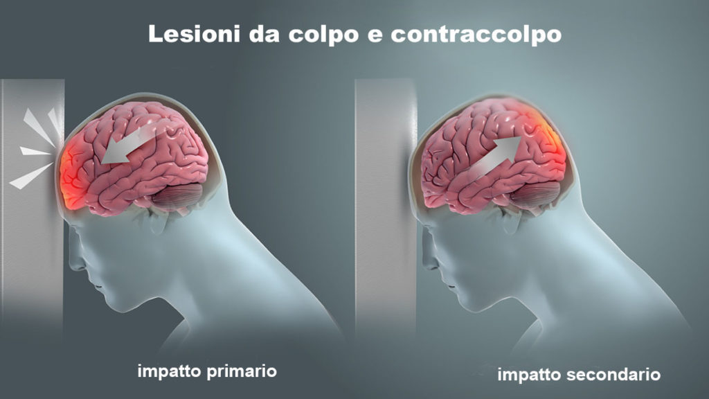 Cannabis terapeutica e lesione cerebrale traumatica